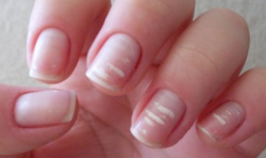 Why white spots appear on nails
