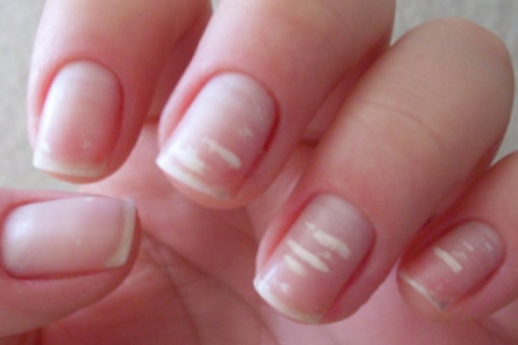 why-white-spots-appear-on-nails-ifbest