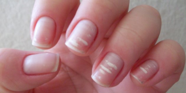 Why white spots appear on nails