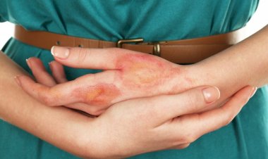 Снимаем боль от ожога. 3 эффективных способа