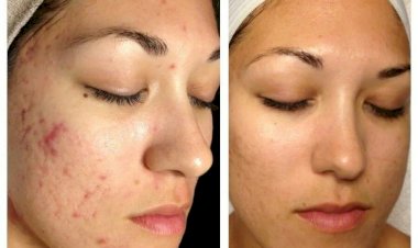 Советы по отшелушиванию кожи: выбор пилинга для каждого типа кожи