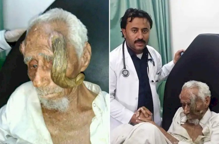 Долгожитель с «дьявольскими рогами»: в Йемене умер 140 летний мужчина