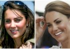 Пластические операции  Кейт Миддлтон