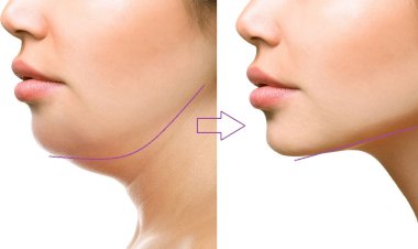 Подтягиваем овал лица и уменьшаем 2 подбородок
