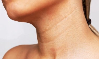 Кольца Венеры на шее - что это такое и что поможет их уменьшить