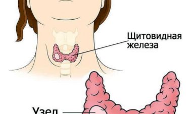 Аутоиммунный тиреодит: что делать, если вам поставили этот диагноз