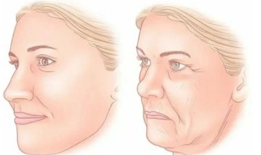 Как подтянуть щеки, уменьшить выраженность брылей и носогубных складок