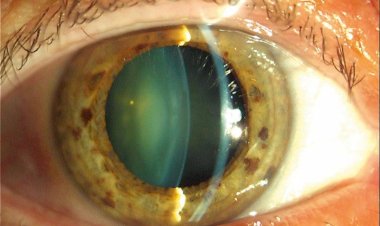 Главное о катаракте