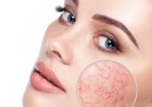 Купероз  - красный нос: как избавиться от красноты на лице