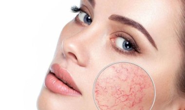 Купероз  - красный нос: как избавиться от красноты на лице