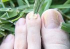 Как избавиться от грибка ногтей с помощью масла чайного дерева?