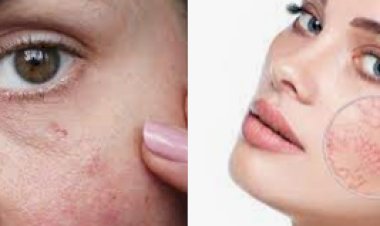 Лечение сосудистых звездочек на лице