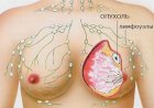 Мифы о раке груди: