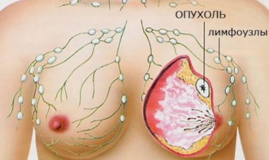 Мифы о раке груди: