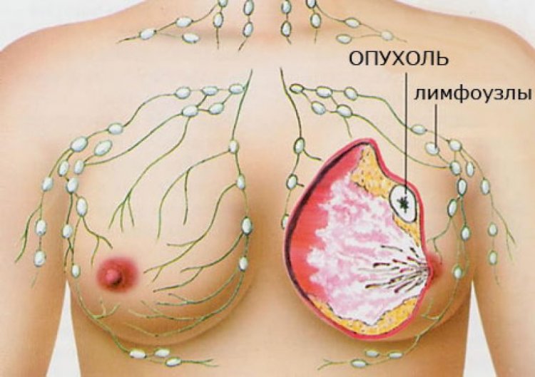 Мифы о раке груди: