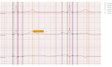 Нахождение и визуализация основных элементов кардиограммы и предсказание по ним болезней сердца