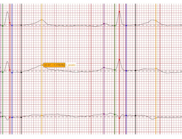 Визуализация сигнала ЭКГ
