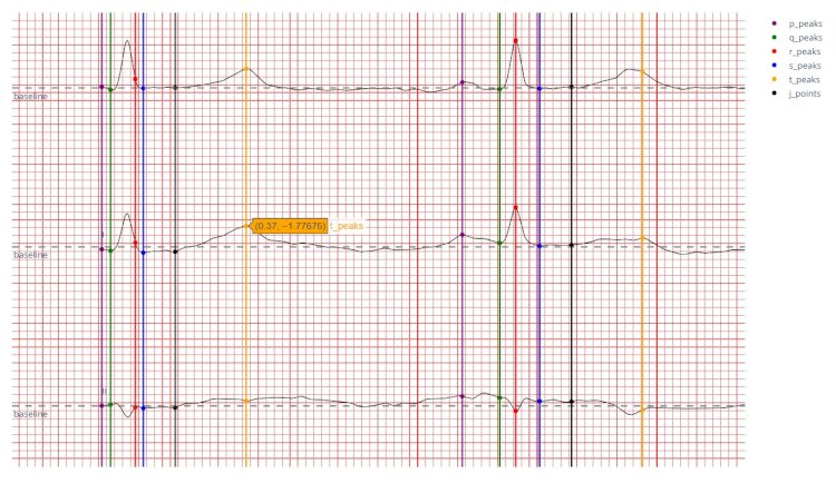 Нахождение и визуализация основных элементов кардиограммы и предсказание по ним болезней сердца